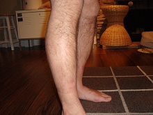leg psoriasis after