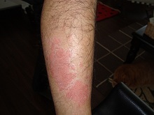 psoriasis before leg eczema