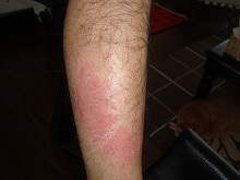 leg psoriasis