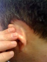 scalp psoriasis after