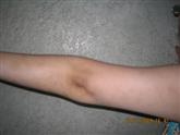 arm psoriasis after treatment