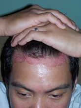 scalp psoriasis before