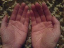 hand eczema 2 weeks after