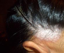 scalp psoriasis before