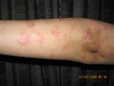 arm psoriasis before