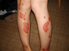 psoriasis before