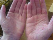 hand eczema before